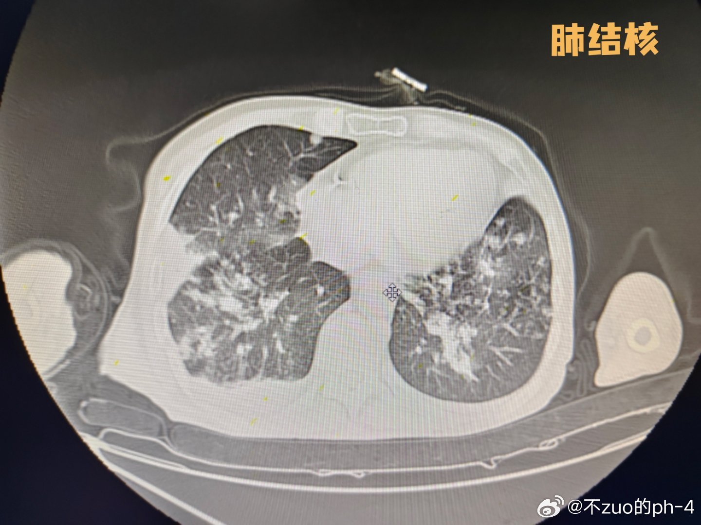 肺部健康最新喜讯：病例动态更新，共筑健康防线